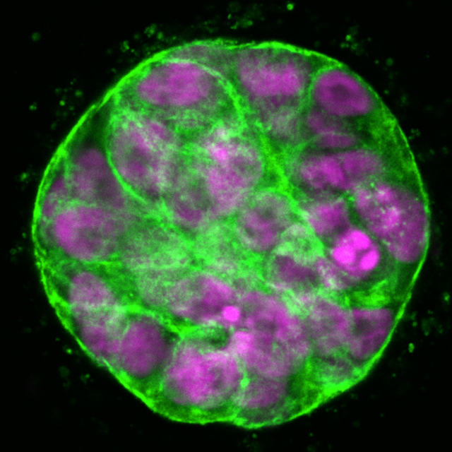 A spheroid of mammary epithelial cells encapsulated in a 3D hydrogel simulating the tumor microenvironment
